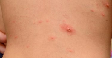 natural remedies for shingles