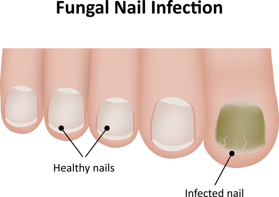 Natural Remedies For Toe Nail Fungus 