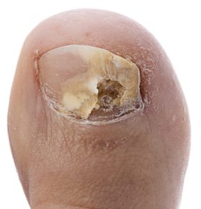 natural remedies for toe nail fungus