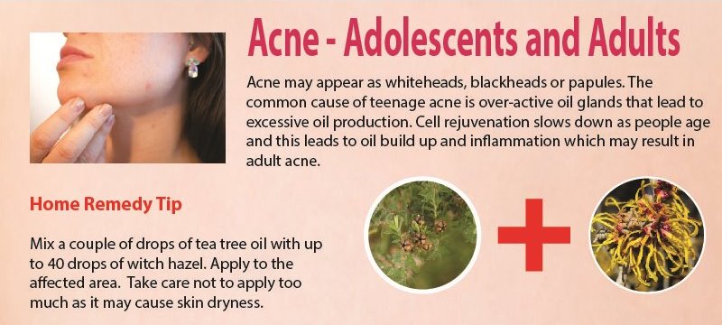natural remedies for acne