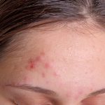 natural remedies for acne