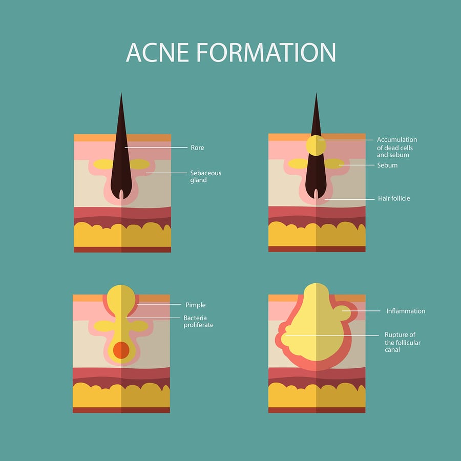 natural remedies for acne - acne formation