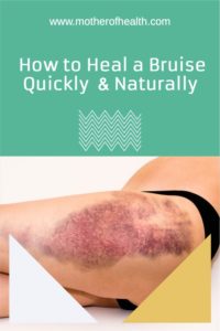 how to heal a bruise quickly