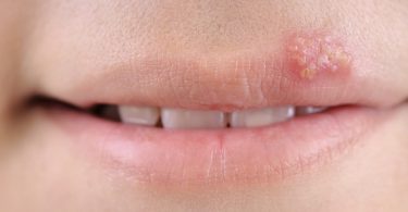 best essential oils for cold sores
