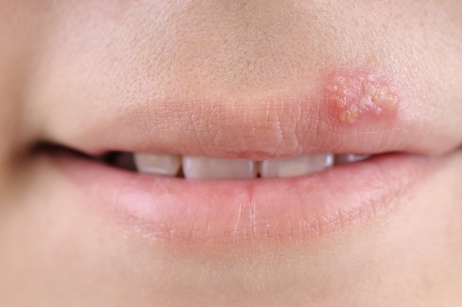 best essential oils for cold sores