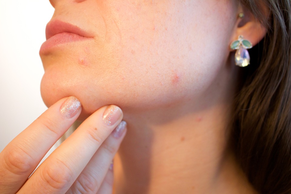 how to get rid of a pimple overnight