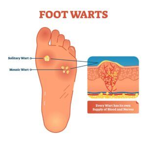 home remedies to remove warts