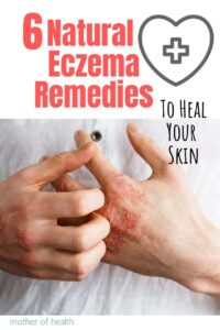 natural eczema remedies