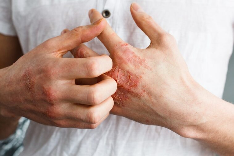 natural eczema remedies