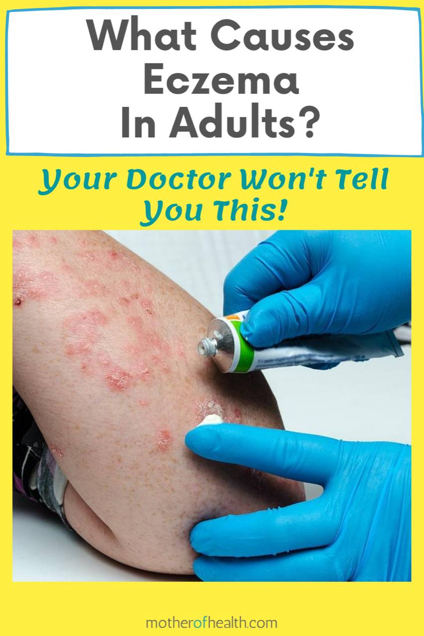 What Causes Eczema In Adults Mother Of Health