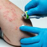 what causes eczema in adults