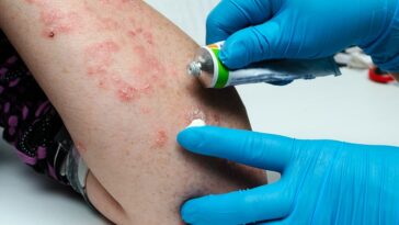 what causes eczema in adults