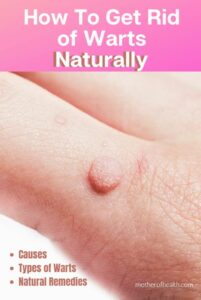 get rid of warts naturally