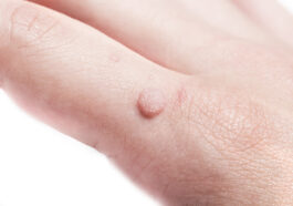 how to get rid of warts naturally