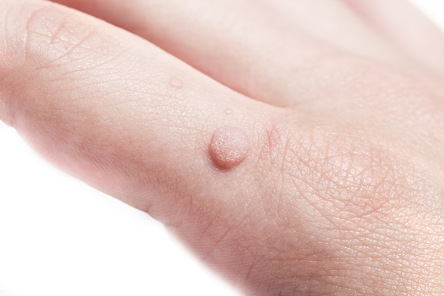 how to get rid of warts naturally