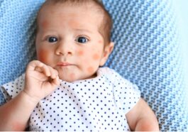 what is baby eczema