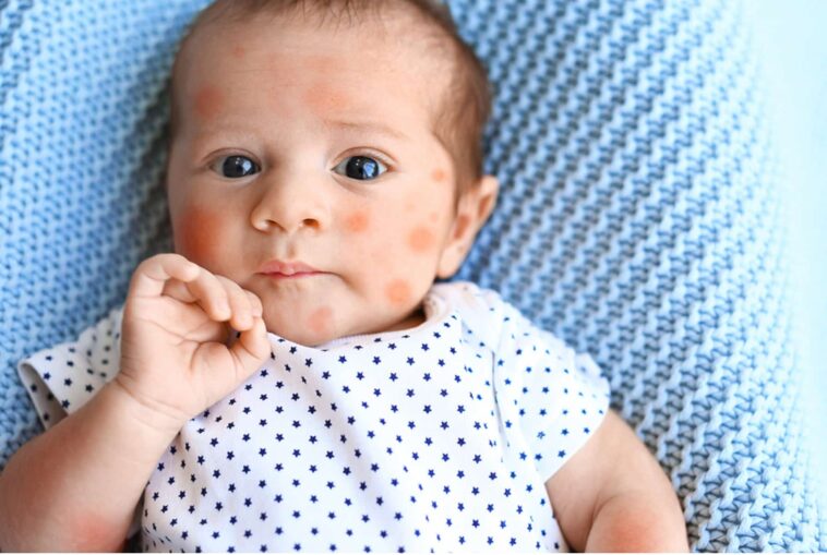 what is baby eczema