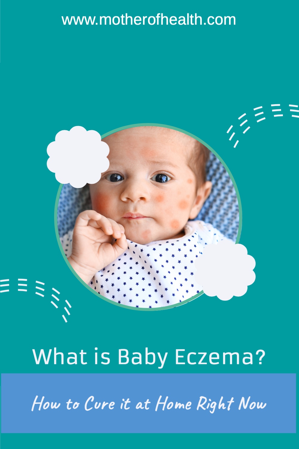 What is Baby Eczema? How to Cure it at Home Right Now Mother Of Health
