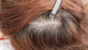 what causes thinning hair in women