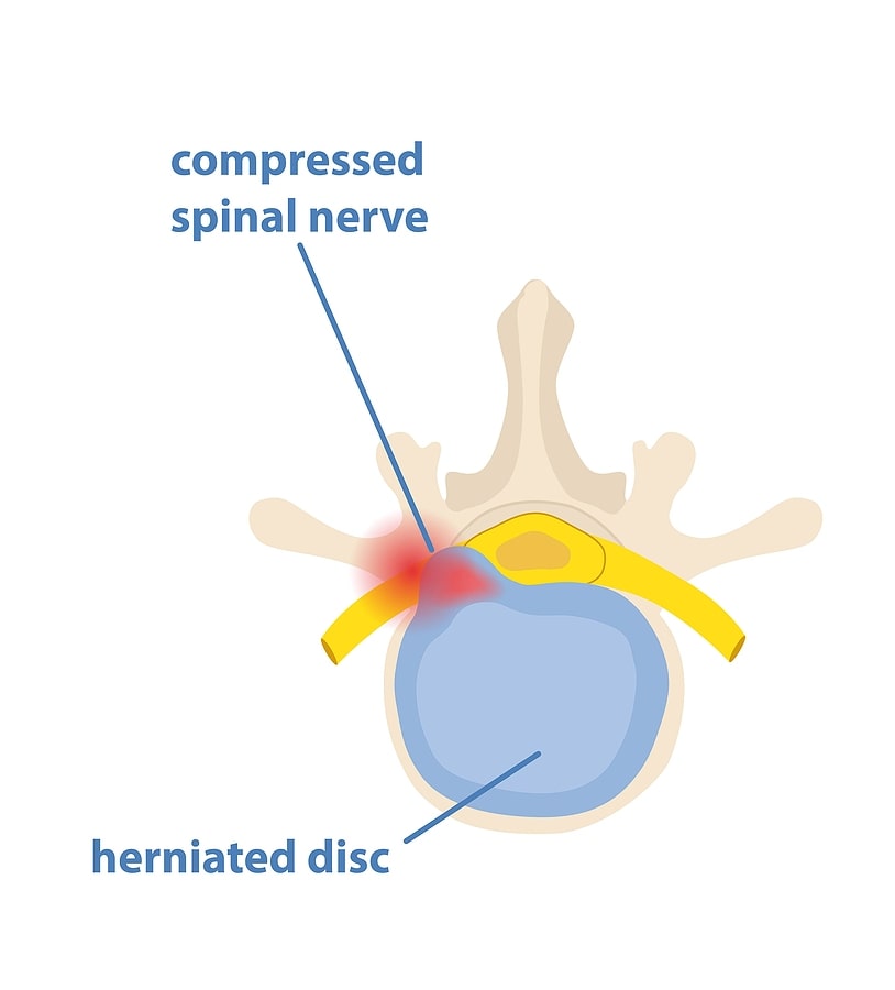compressed spinal nerve (infographic image)