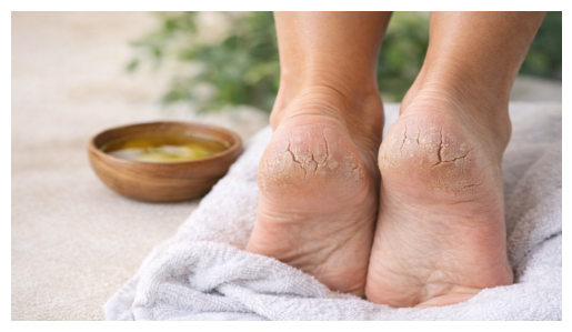 dry cracked heels resting on a towel with bowl of oil Ayurvedic foot care